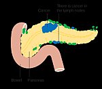 Diagram showing pancreatic cancer in the lymph nodes (N staging) CRUK 178